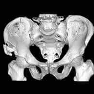 骨盤の3次元画像