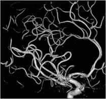 血管の3次元画像