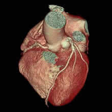 心臓の3次元画像