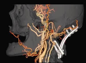 頚部血管の3次元画像