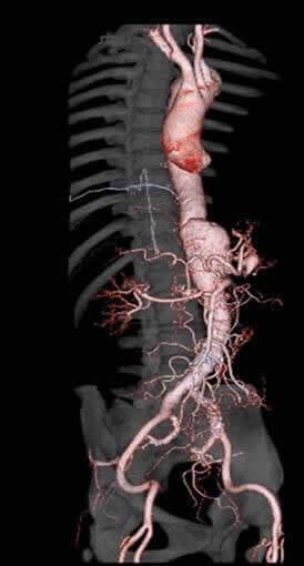 腹部血管にできた大きな瘤