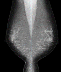 マンモグラフィー画像2