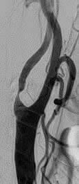 内頚動脈狭窄に対するステント留置